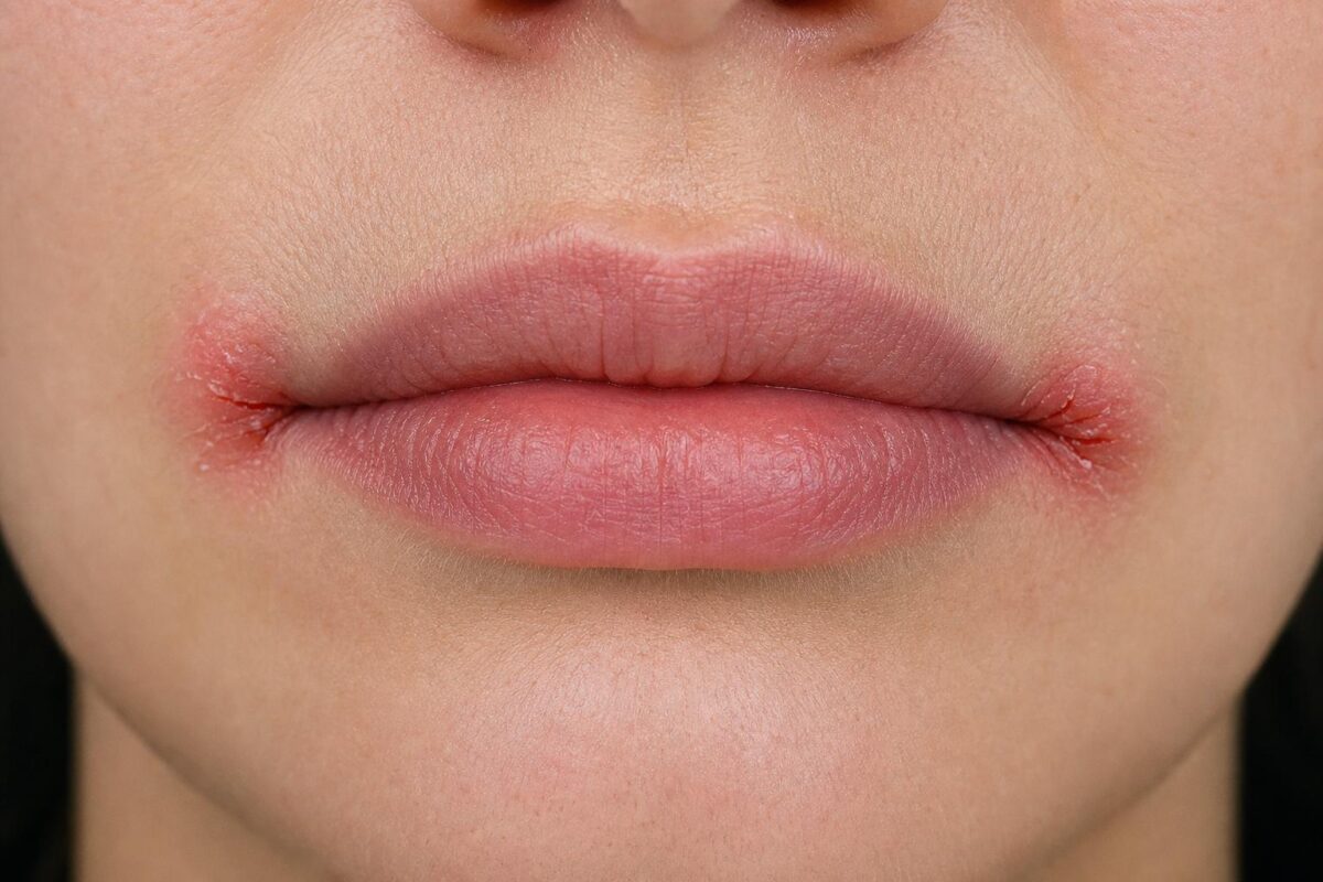 Commissure des lèvres : comprendre les causes cachées et les soins qui changent tout